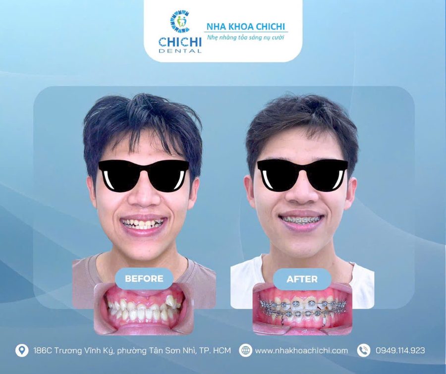 Before and after orthodontic treatment - Client 1
