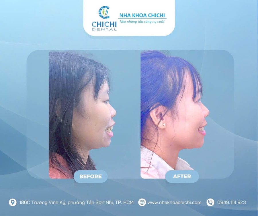 Before and after orthodontic treatment - Client 10