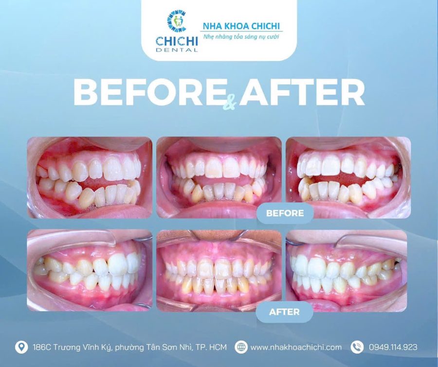 Before and after orthodontic treatment - Client 11
