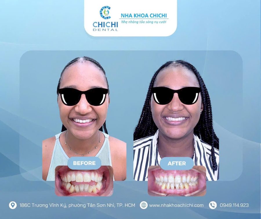Before and after orthodontic treatment - Client 12
