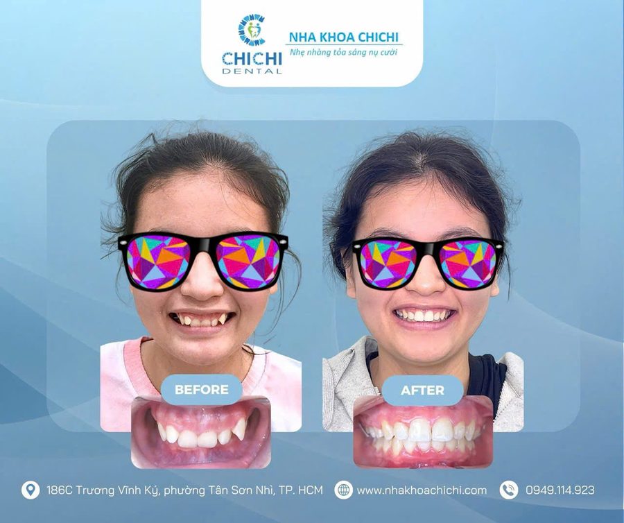 Before and after orthodontic treatment - Client 13