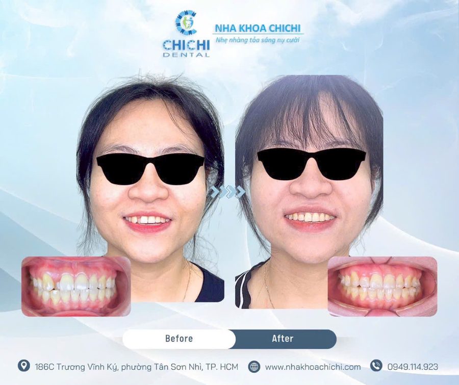 Before and after orthodontic treatment - Client 14