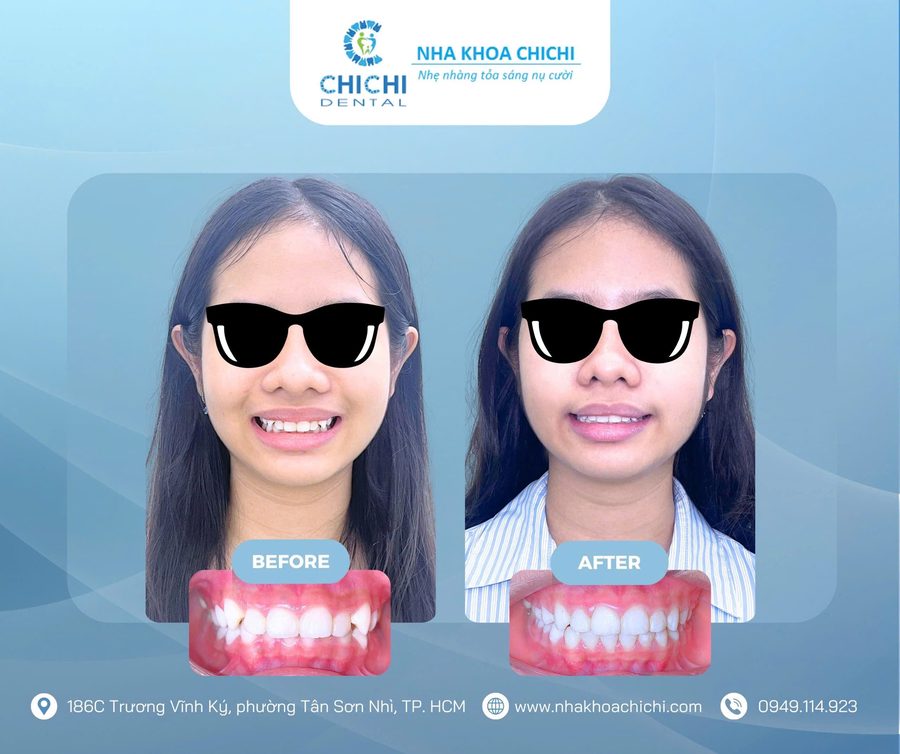 Before and after orthodontic treatment - Client 15