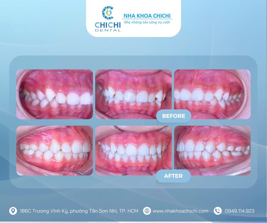 Before and after orthodontic treatment - Client 16