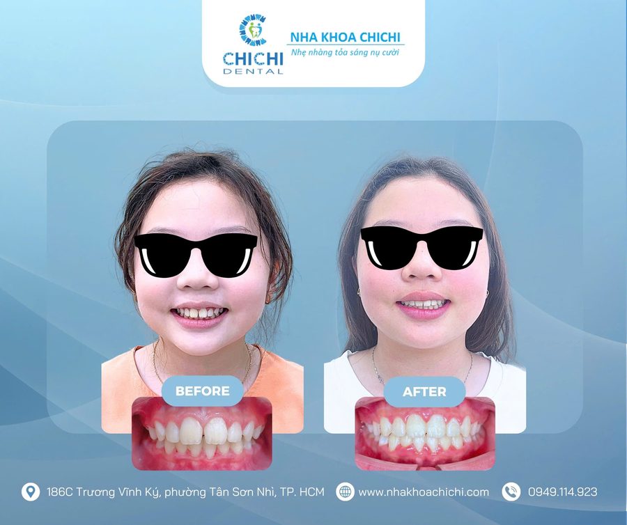 Before and after orthodontic treatment - Client 17