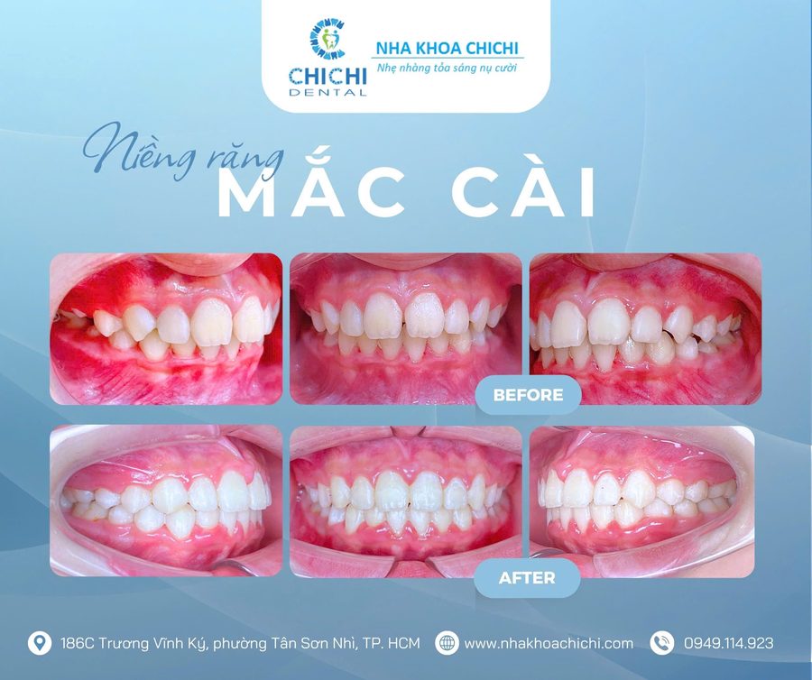 Before and after orthodontic treatment - Client 18
