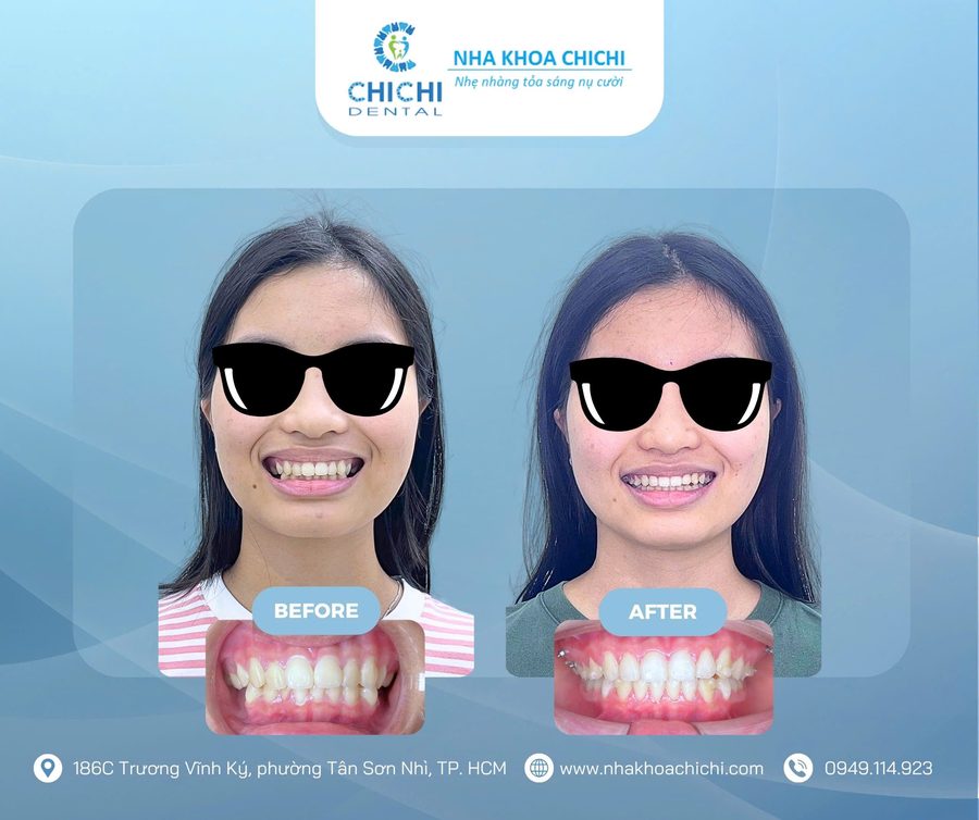 Before and after orthodontic treatment - Client 19