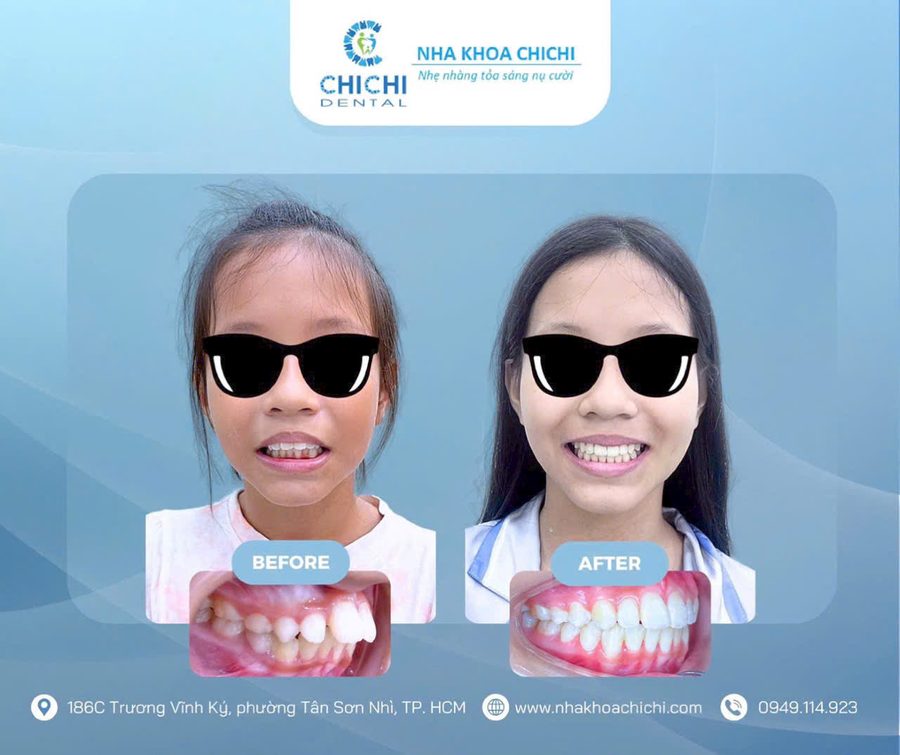 Before and after orthodontic treatment - Client 2