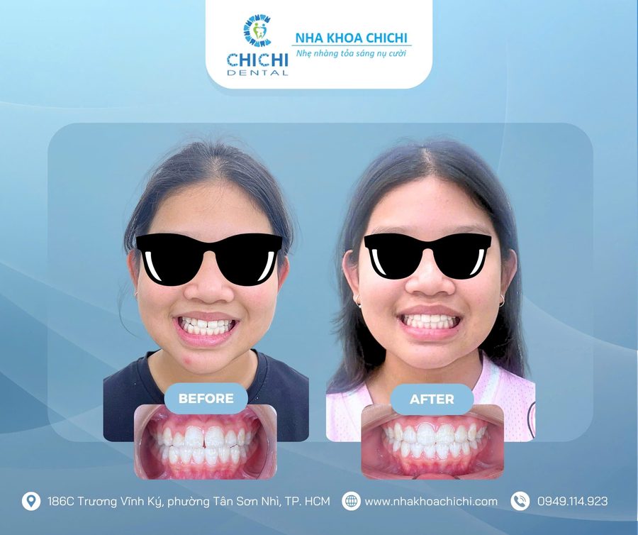 Before and after orthodontic treatment - Client 20