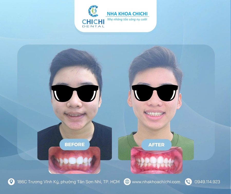 Before and after orthodontic treatment - Client 21