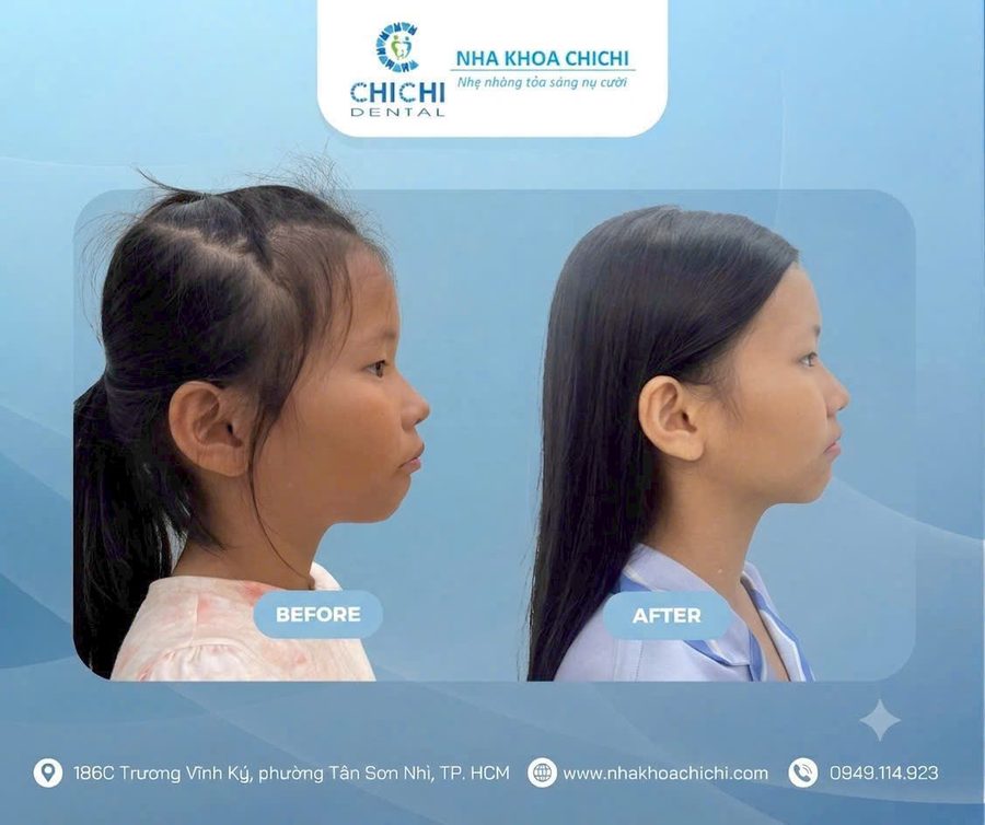 Before and after orthodontic treatment - Client 3
