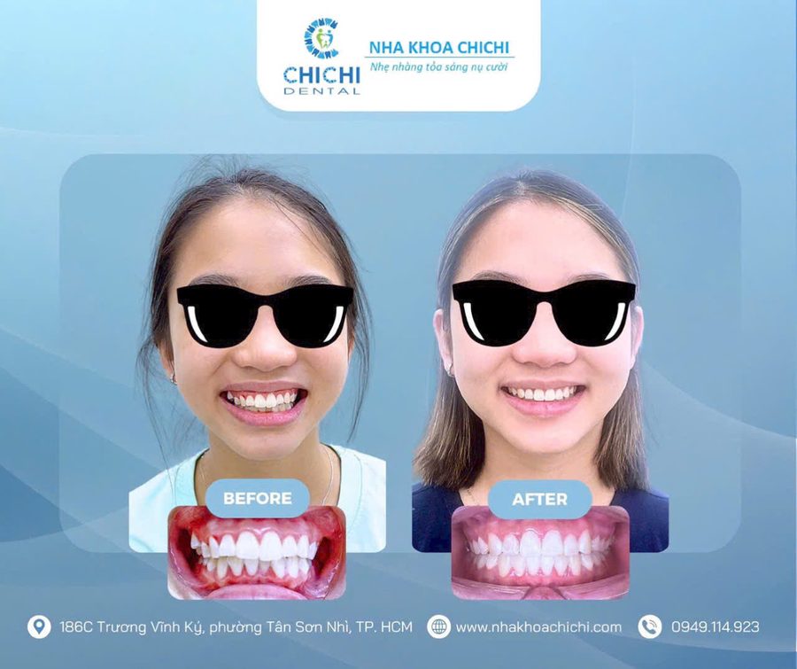 Before and after orthodontic treatment - Client 4