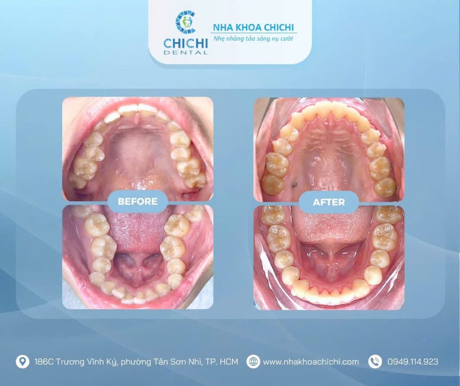 Before and after orthodontic treatment - Client 5