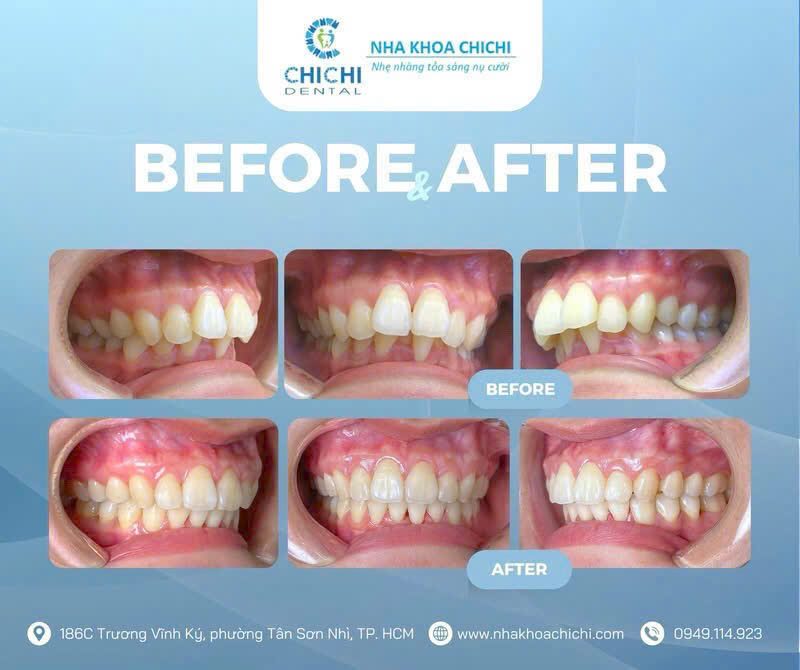 Before and after orthodontic treatment - Client 6