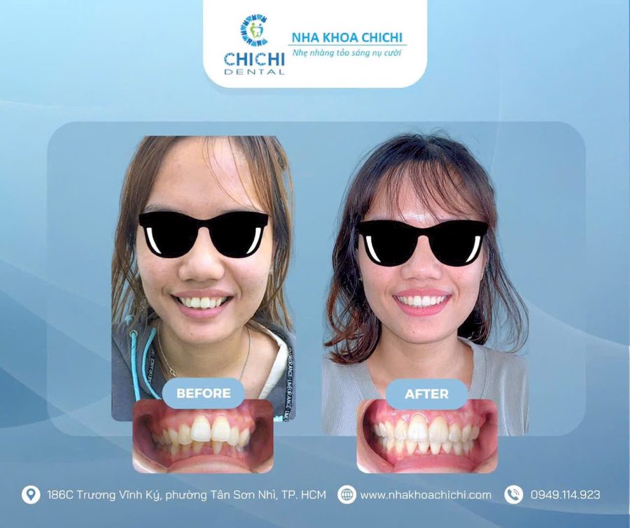 Before and after orthodontic treatment - Client 7