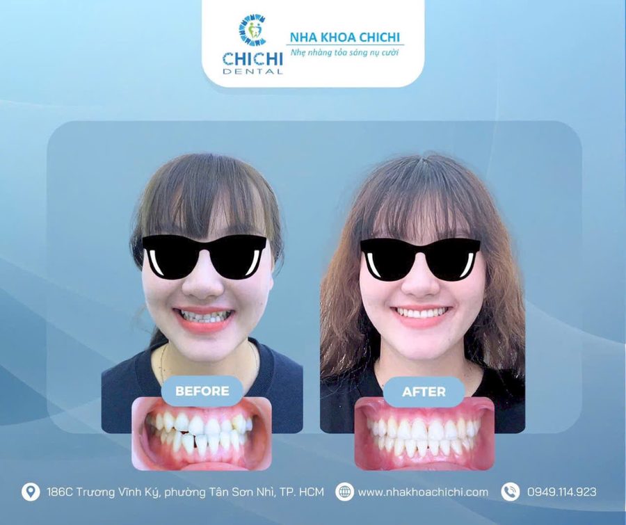 Before and after orthodontic treatment - Client 8