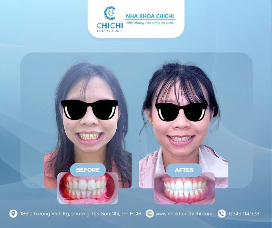 Before and after orthodontic treatment - Client 9
