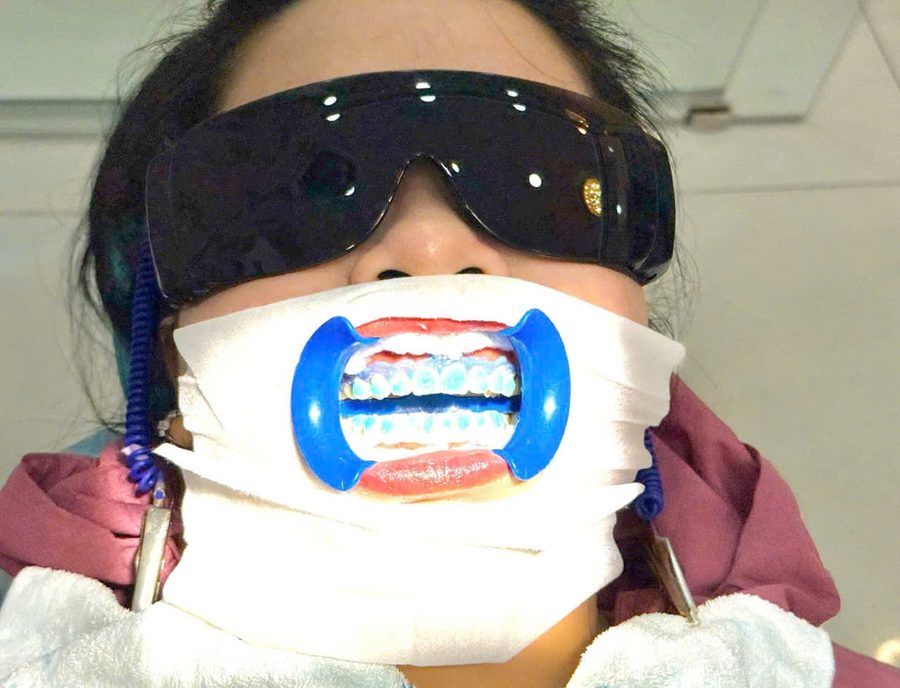 Close-up of laser teeth whitening treatment
